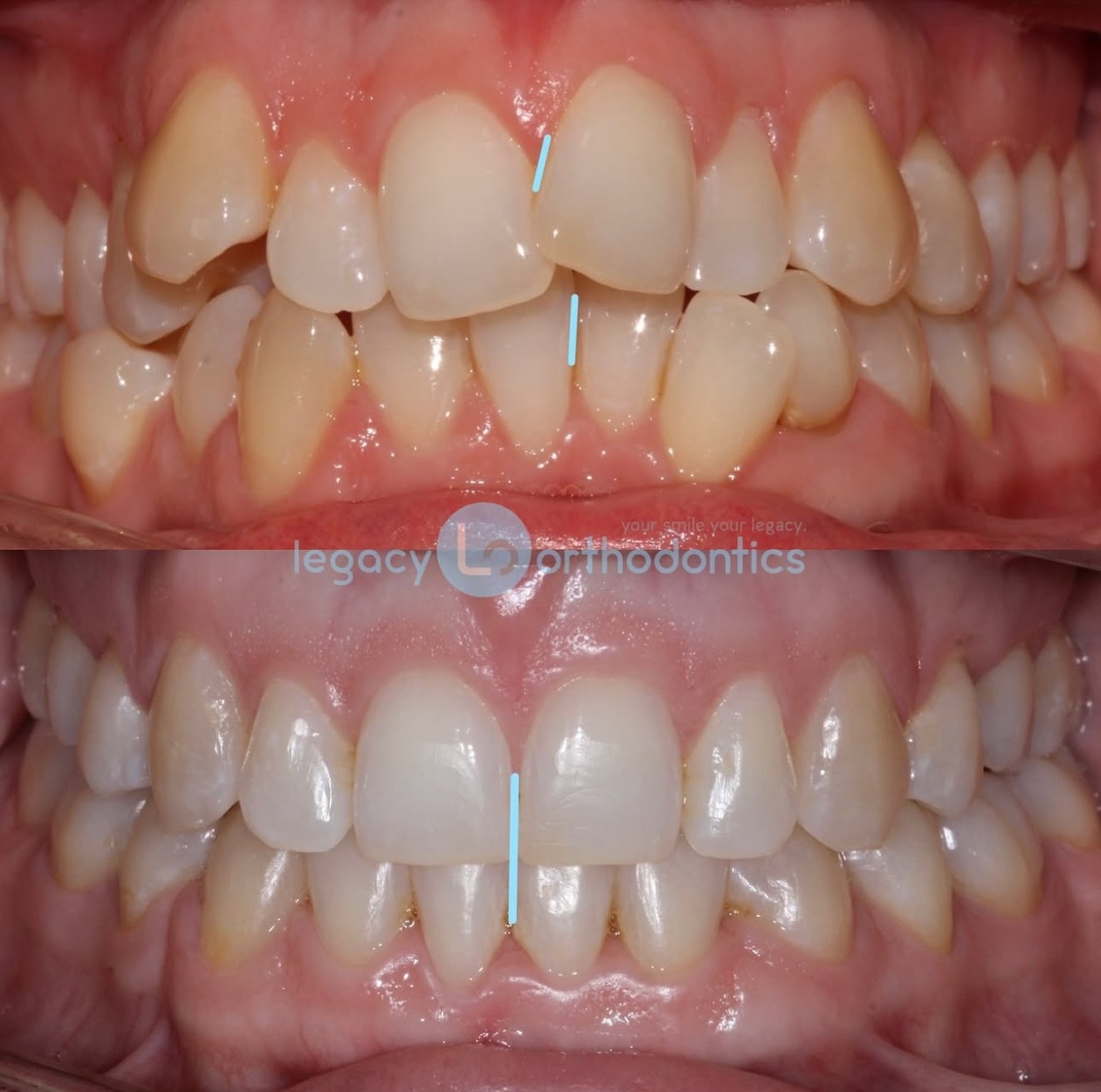 before and after