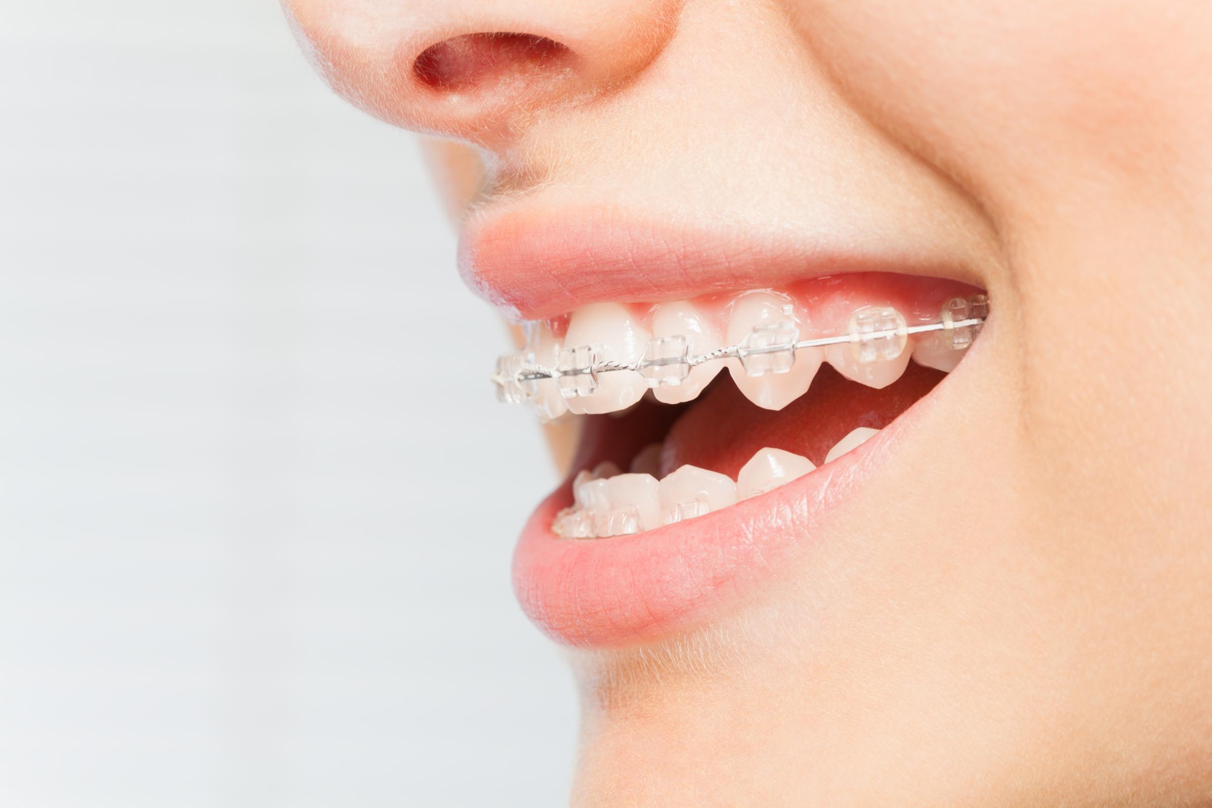 GettyImages-918796064 (1) orthodontist sterling va