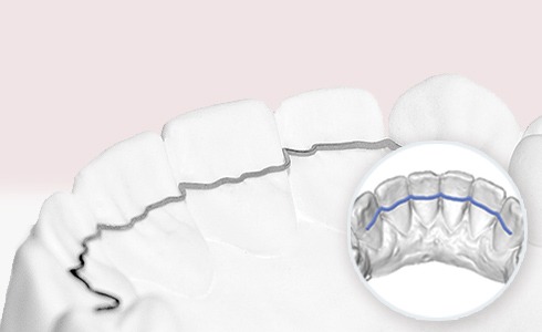 memotain invisalign leesburg va