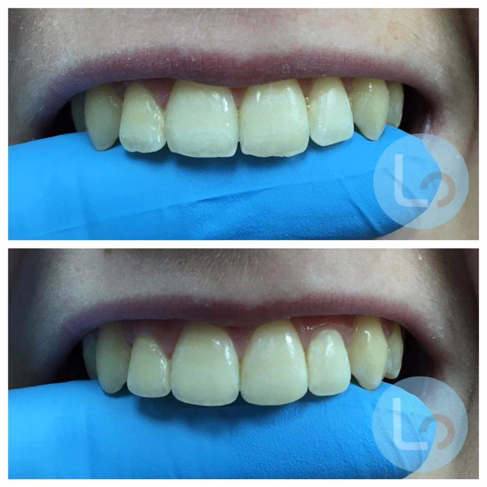 Before and After Orthodontic Treatment enameloplasty before and after
