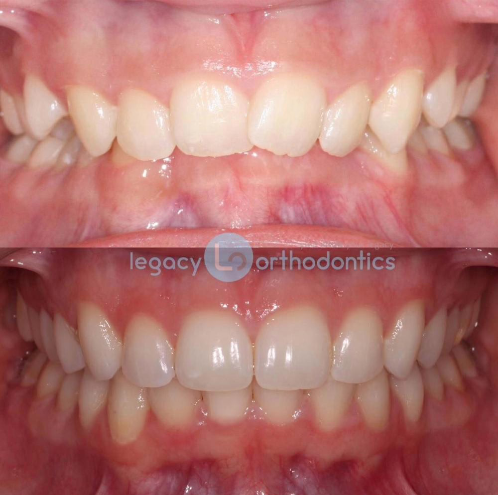 before and after photo